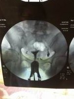 二代试管做羊穿有什么好处？想做试管的姐妹建议了解