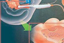 确诊为免疫性不孕能在漯河市做试管婴儿吗？做三代试管需要多少钱？